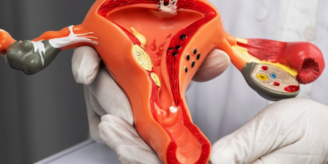 Cáncer cervical: la amenaza silenciosa que crece entre mujeres jóvenes