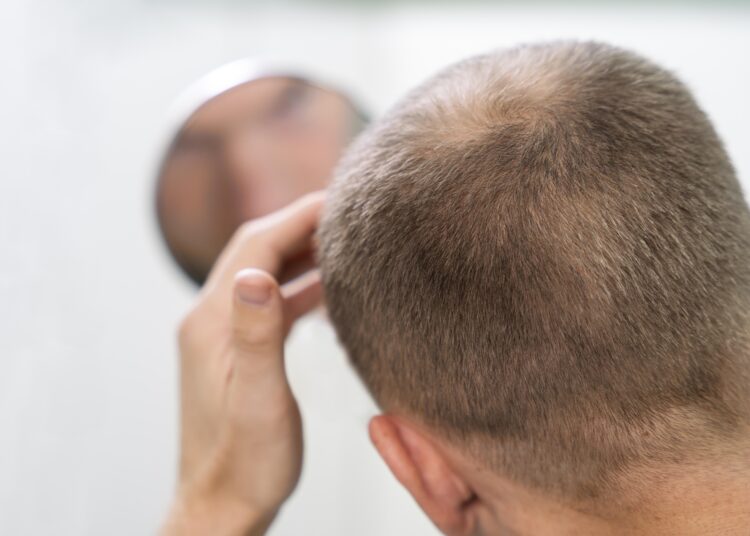 La terapia celular abre una nueva vía para acabar con la calvicie