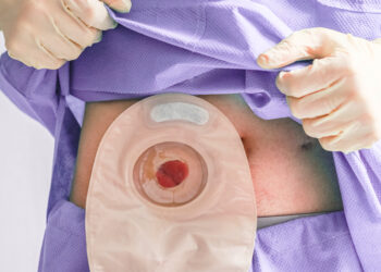 La vida después del cáncer colorrectal: el desafío de vivir con una bolsa de ostomía