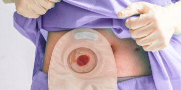 La vida después del cáncer colorrectal: el desafío de vivir con una bolsa de ostomía