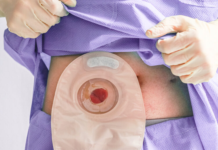 La vida después del cáncer colorrectal: el desafío de vivir con una bolsa de ostomía