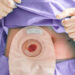 La vida después del cáncer colorrectal: el desafío de vivir con una bolsa de ostomía
